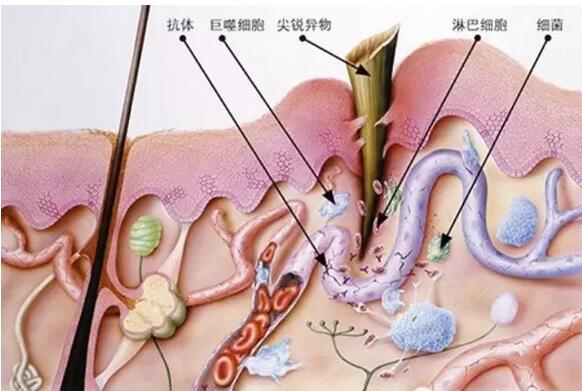 為什么傷口會發(fā)炎