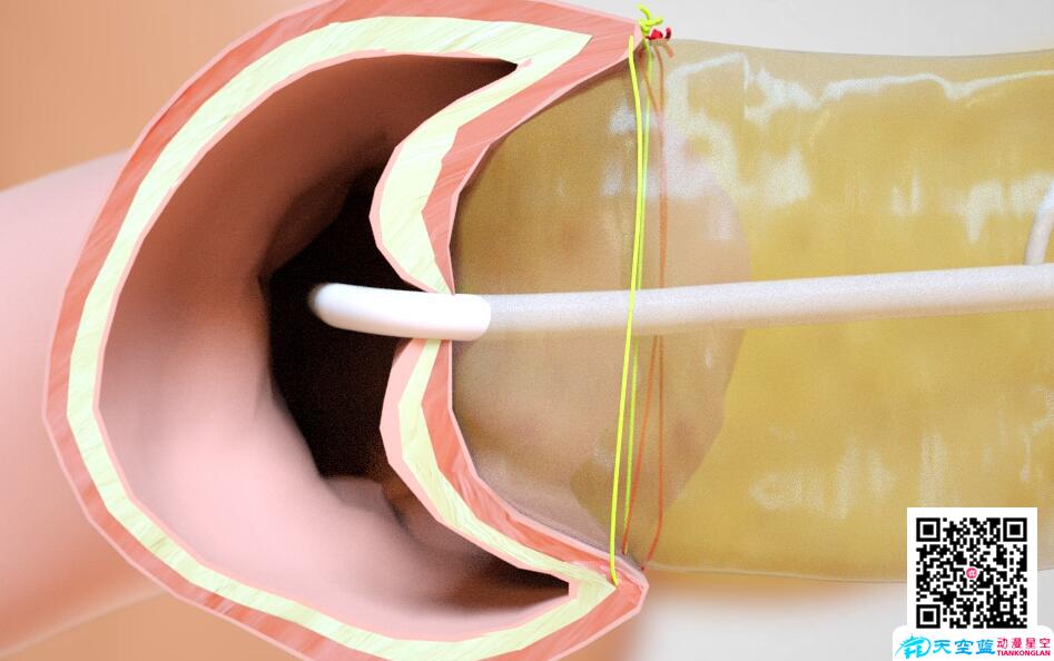 三維3d動畫演示胰十二指腸切除術(shù)8.jpg