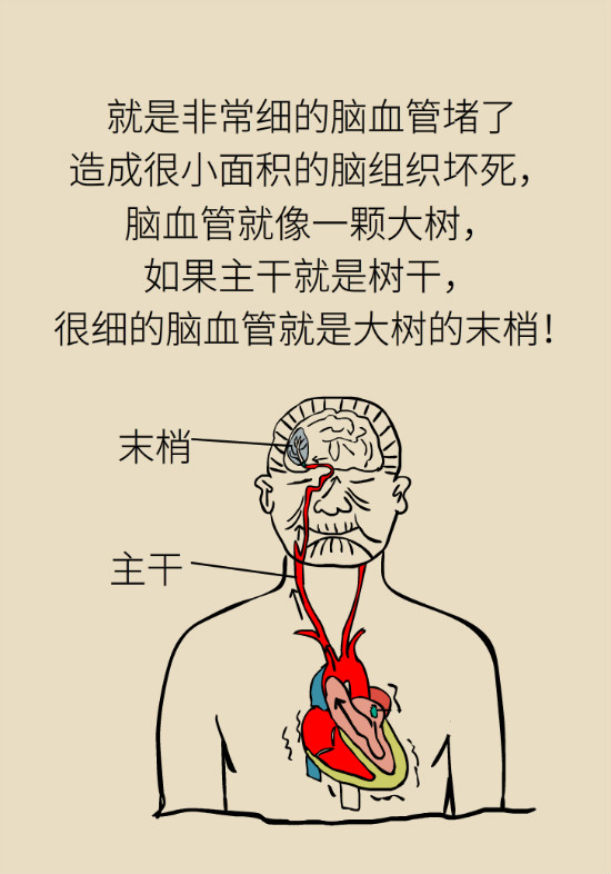 腔隙性腦梗死一定是腦血管堵了嗎？