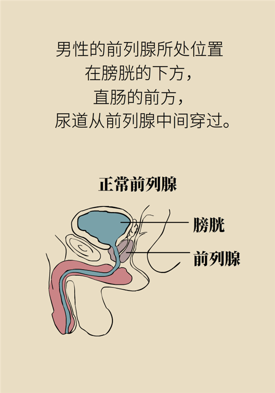 前列腺肥大了還能縮小嗎？