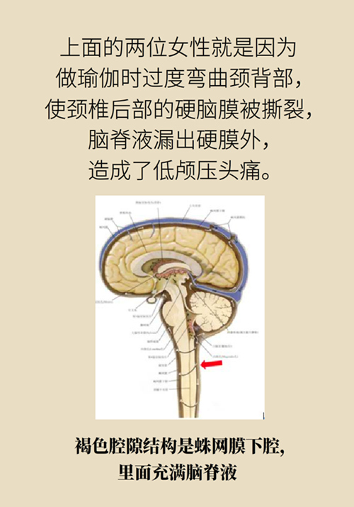 練瑜伽把腦脊液拉漏了！常見的“瑜伽病”你知道多少