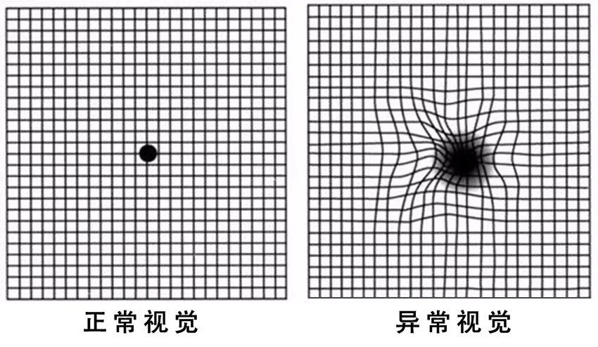 糖尿病患者出現(xiàn)這個癥狀，可能是失明前兆