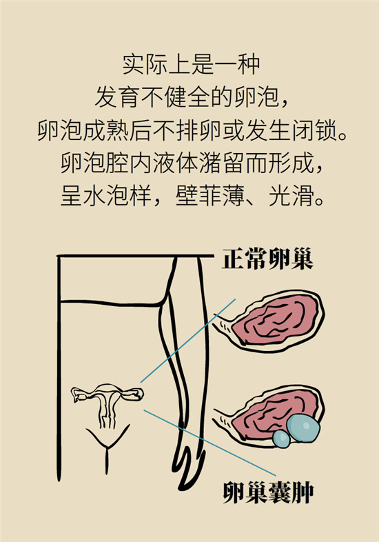 卵巢囊腫科普動(dòng)漫：卵巢囊腫是腫瘤嗎？要學(xué)會(huì)這樣區(qū)分