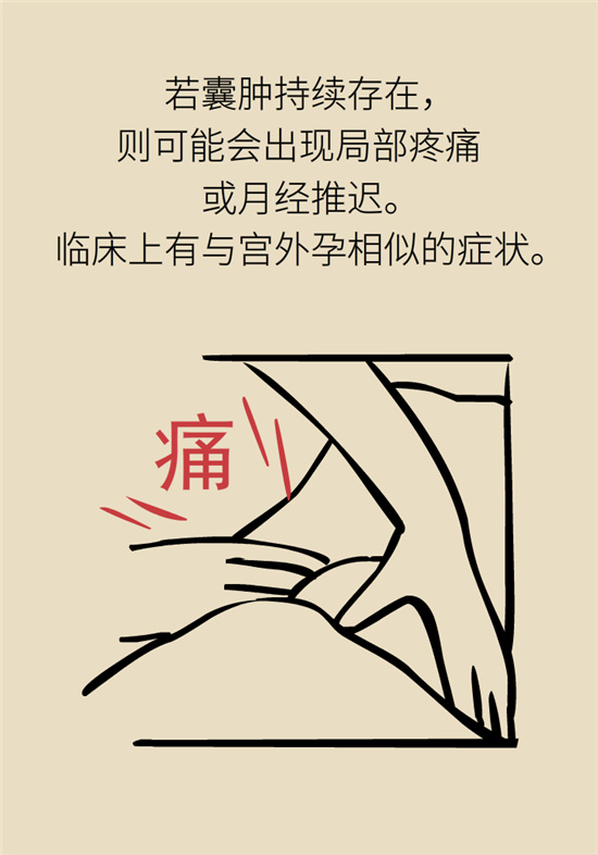 卵巢囊腫科普動(dòng)漫：卵巢囊腫是腫瘤嗎？要學(xué)會(huì)這樣區(qū)分