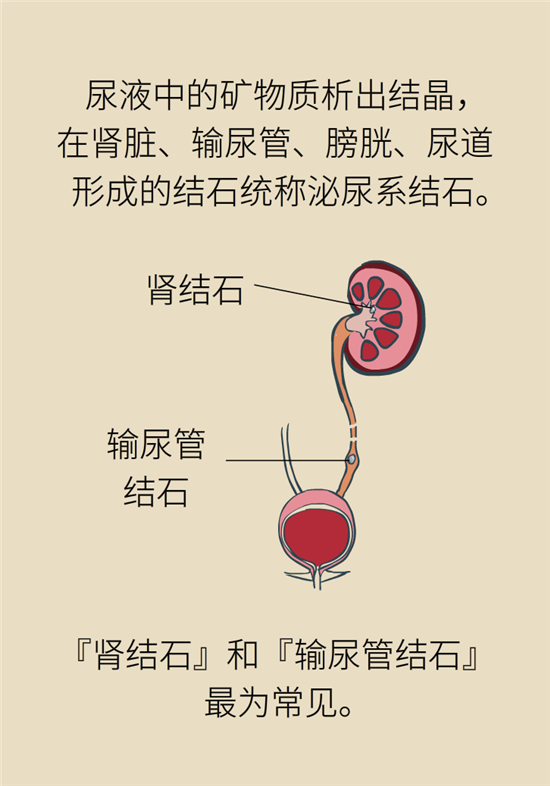 結(jié)石科普：身體里多了各種結(jié)石，應(yīng)該怎么辦？