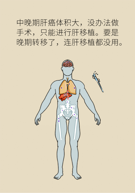 論發(fā)現(xiàn)早期肝癌的本事，cfDNA比AFP更精準(zhǔn)，比影像學(xué)更早一步