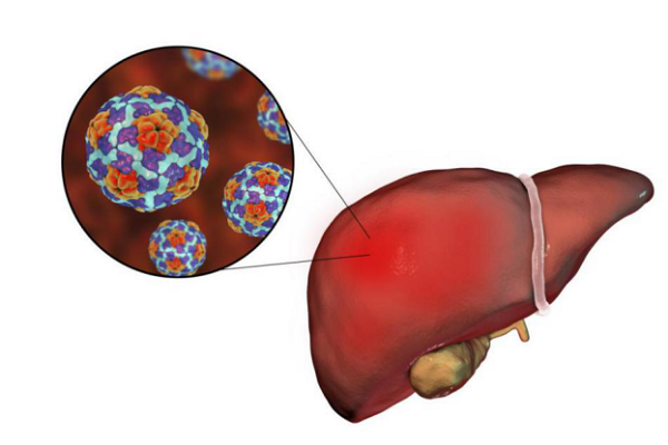 世界肝炎日：得了肝炎一定會(huì)得肝癌嗎？