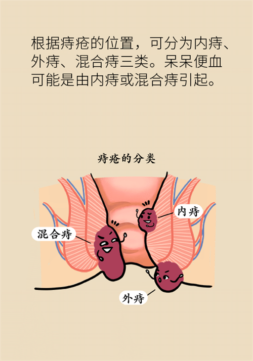 肛門腫脹還有血？小心痔瘡找上門