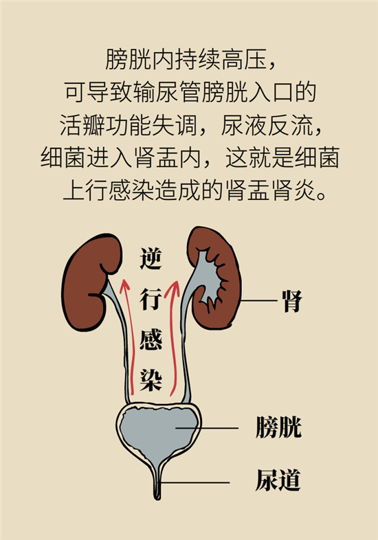 經(jīng)常憋尿會得急性腎炎？