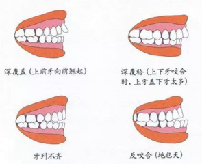 兒童換牙常見(jiàn)3大問(wèn)題，保護(hù)牙齒需要做好這5點(diǎn)