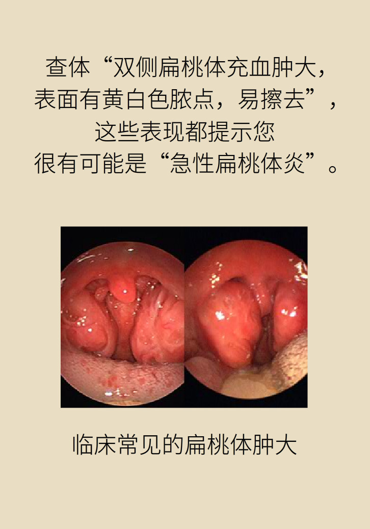 單側(cè)扁桃體腫大更兇險！謹防惡性腫瘤