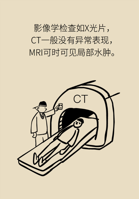 梨狀肌綜合征