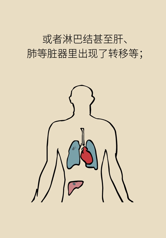 乳腺癌復(fù)發(fā)、轉(zhuǎn)移了怎么辦？