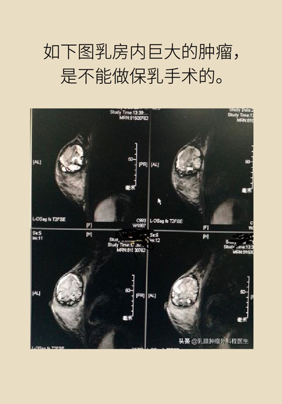 乳腺癌科普動漫