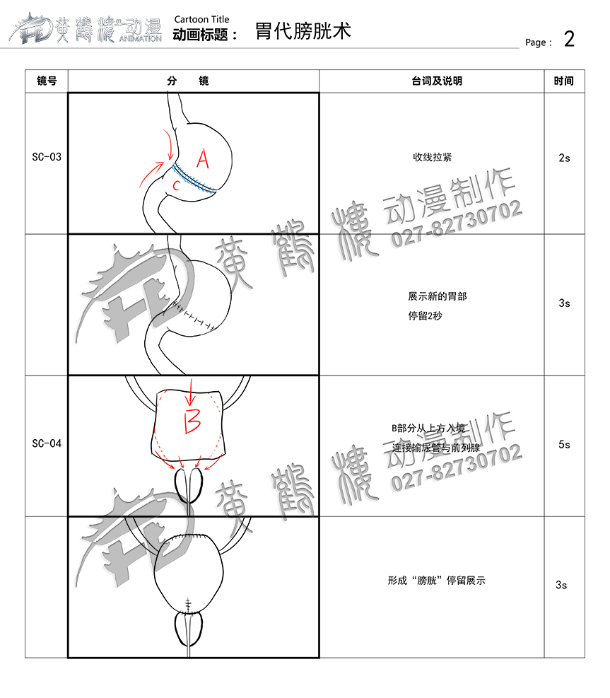 胃代膀胱術(shù)醫(yī)療手術(shù)動畫制作2.jpg