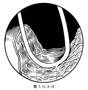 經(jīng)尿道前列腺切除術(shù)